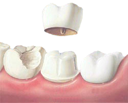 Dental Veneers