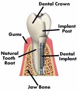 Dental Veneers