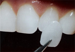 Dental Veneers